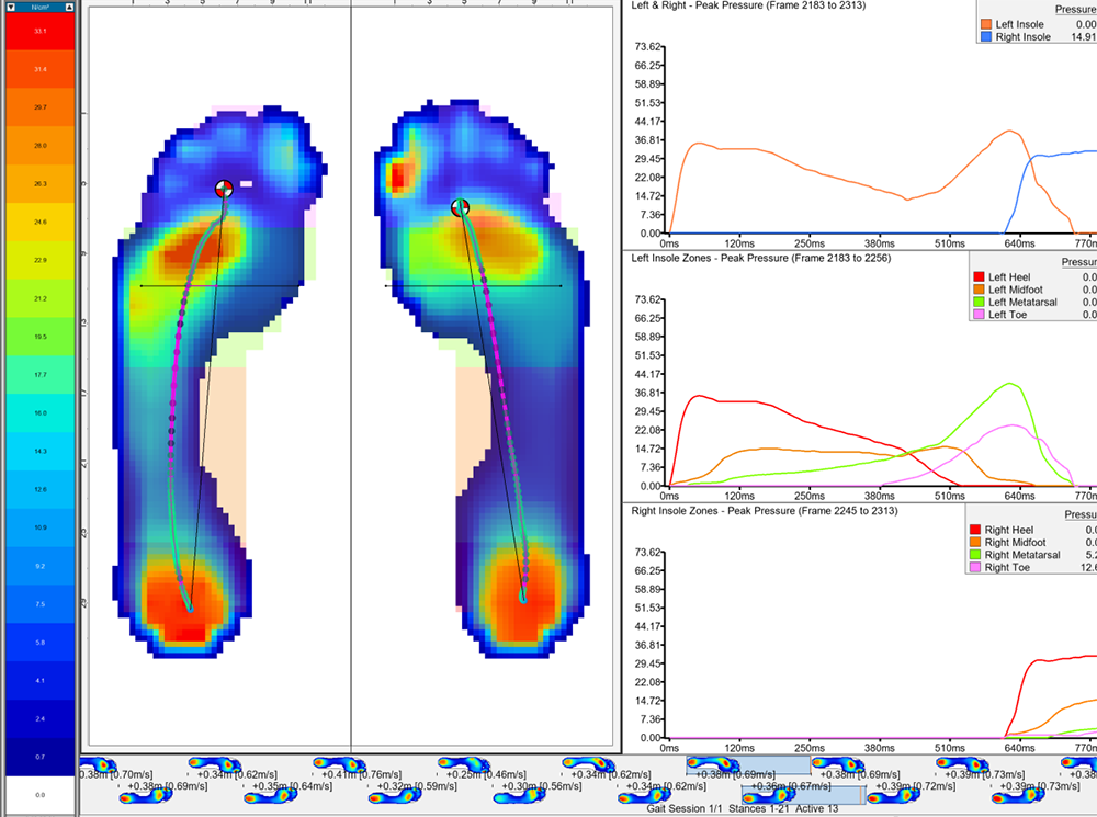 Plantar pressure data displayed in XSENSOR's Foot & Gait Pro software.