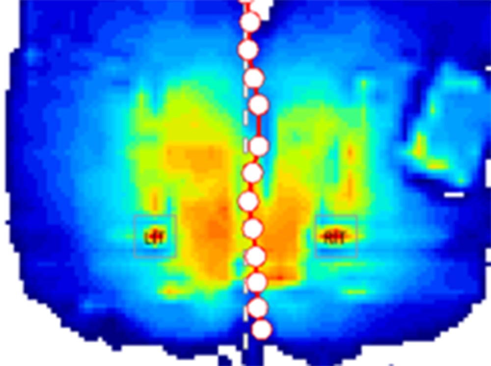 XSENSOR's ForeSite SS Wheelchair Seat System pressure map showing a user's pelvic alignment. XSENSOR's ForeSite SS Wheelchair Seat System pressure map showing a user's pelvic alignment.