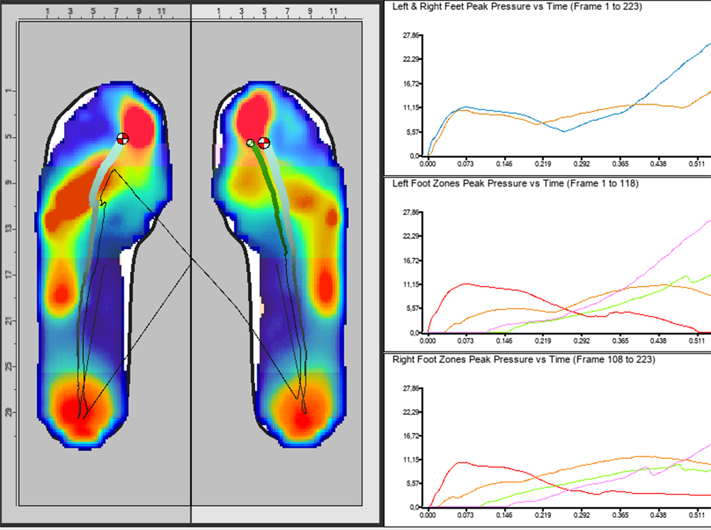 Plantar pressure data from XSENSOR's Foot & Gait Clinical software.