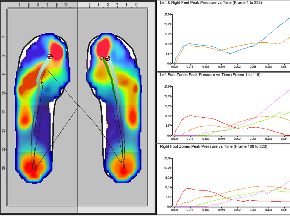 Plantar pressure data from XSENSOR's Foot & Gait Clinical software. Plantar pressure data from XSENSOR's Foot & Gait Clinical software.