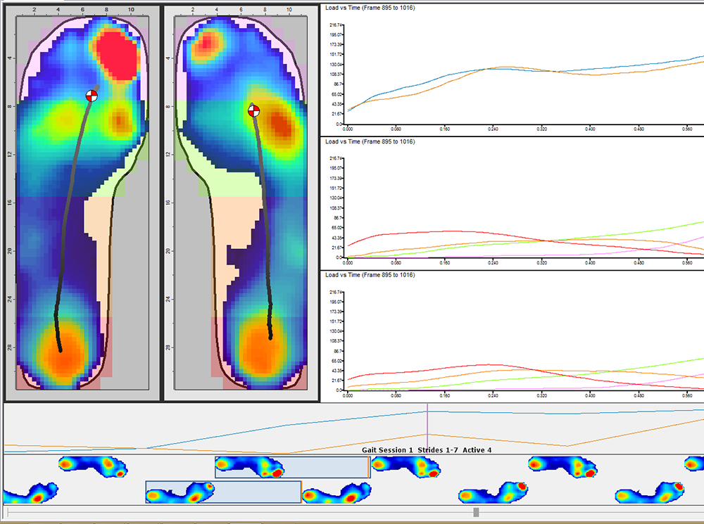 XSENSOR Technology's Pro Foot & Gait software showing a user's plantar pressure data in high-resolution detail.