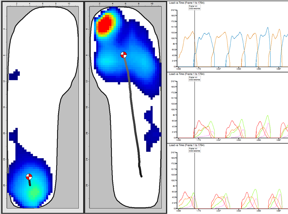 Plantar pressure data of two feet on XSENSOR's Foot & Gait software platform.