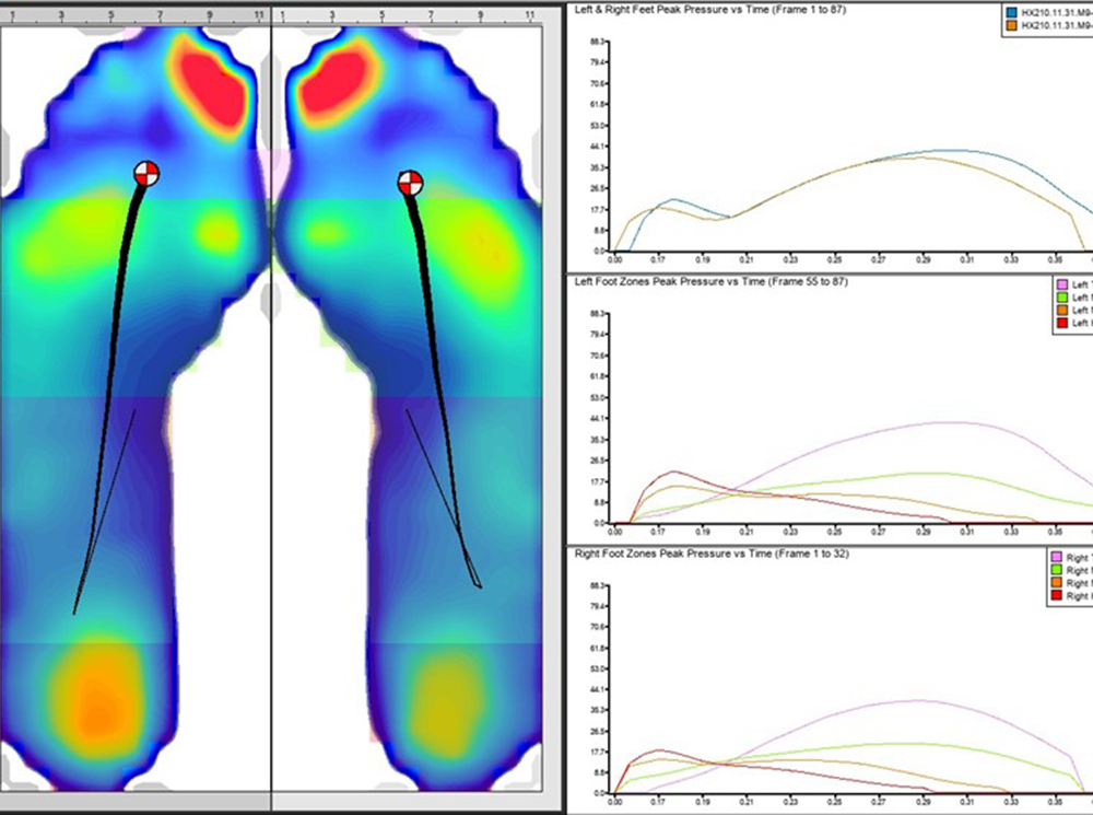 XSENSOR's Pro Foot & Gait software screenshot showing plantar pressure differences in two feet.