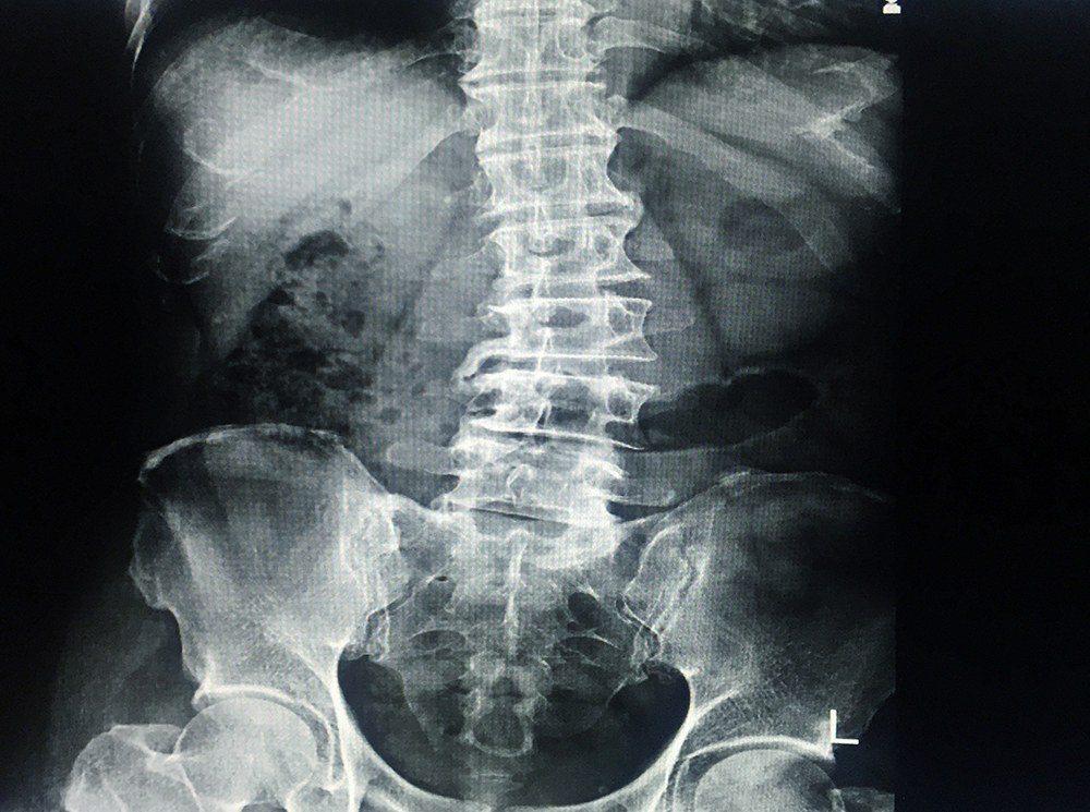 X-ray of a person with Scoliosis.