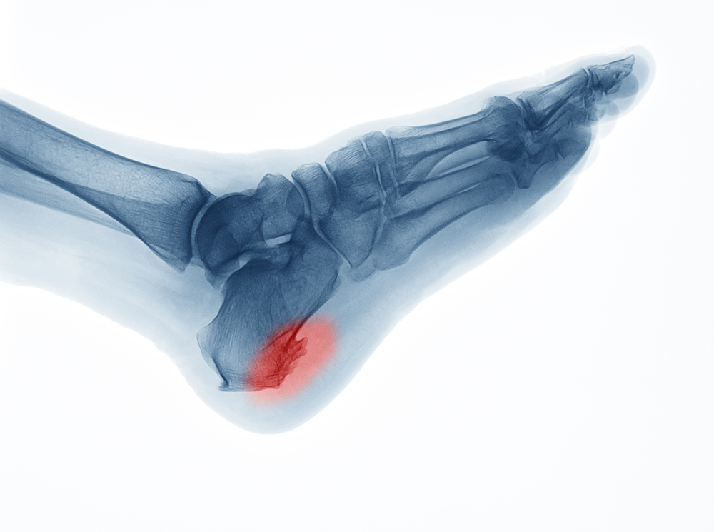 X-Ray of individual's foot.