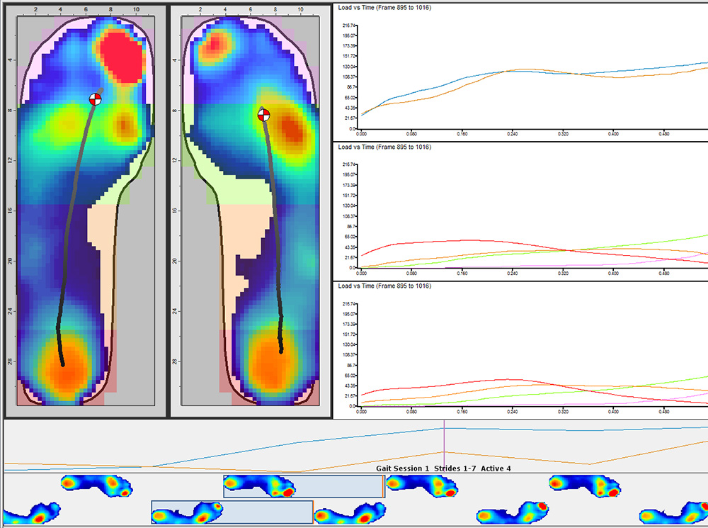 Plantar pressure data captured using XSENSOR's Intelligent Insoles.